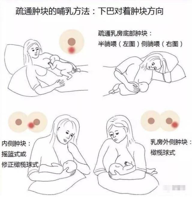 產(chǎn)后漲奶，疼痛難忍怎么辦？