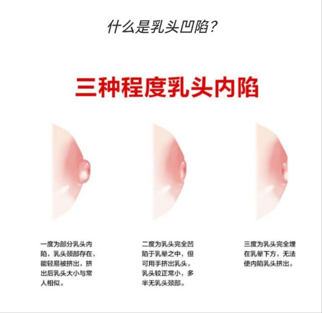 乳頭凹陷的媽媽該如何哺乳？