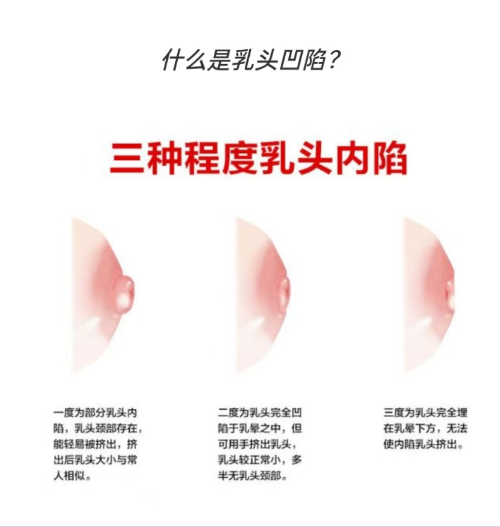 乳頭凹陷媽媽也能成功哺乳：應(yīng)對(duì)策略與孕期準(zhǔn)備